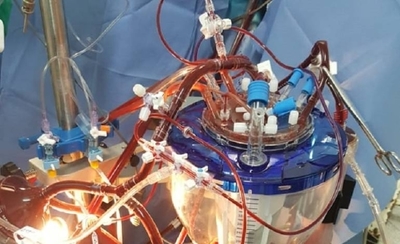 Primera cirugía de aorta con técnica mini invasiva: paciente cardiaca con buena evolución