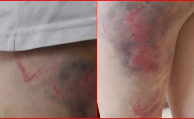 Brutal castigo y agresión a niña de 9 años