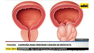 Cáncer de próstata: el más curable y el más mortal