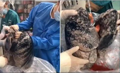 Así quedaron los pulmones de un hombre que fumó durante 30 años y murió