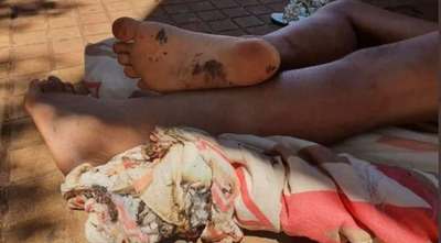 CDE: Hallan a mujer indigente con una ampolla en los pies tras quemadura