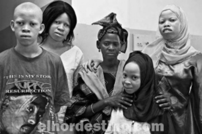La terrorífica pesadilla de ser una persona albina en África y de la que todo el mundo debería enterarse